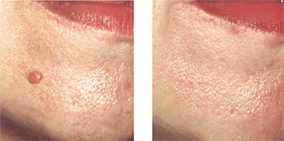 derma_s17