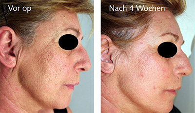derma_s30